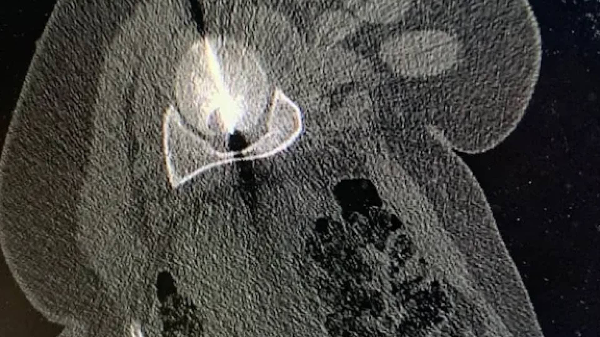 مستشفى الجامعة الأردنية ينجح بعلاج ورم رأس عظم الفخذ بتقنية المايكروويف