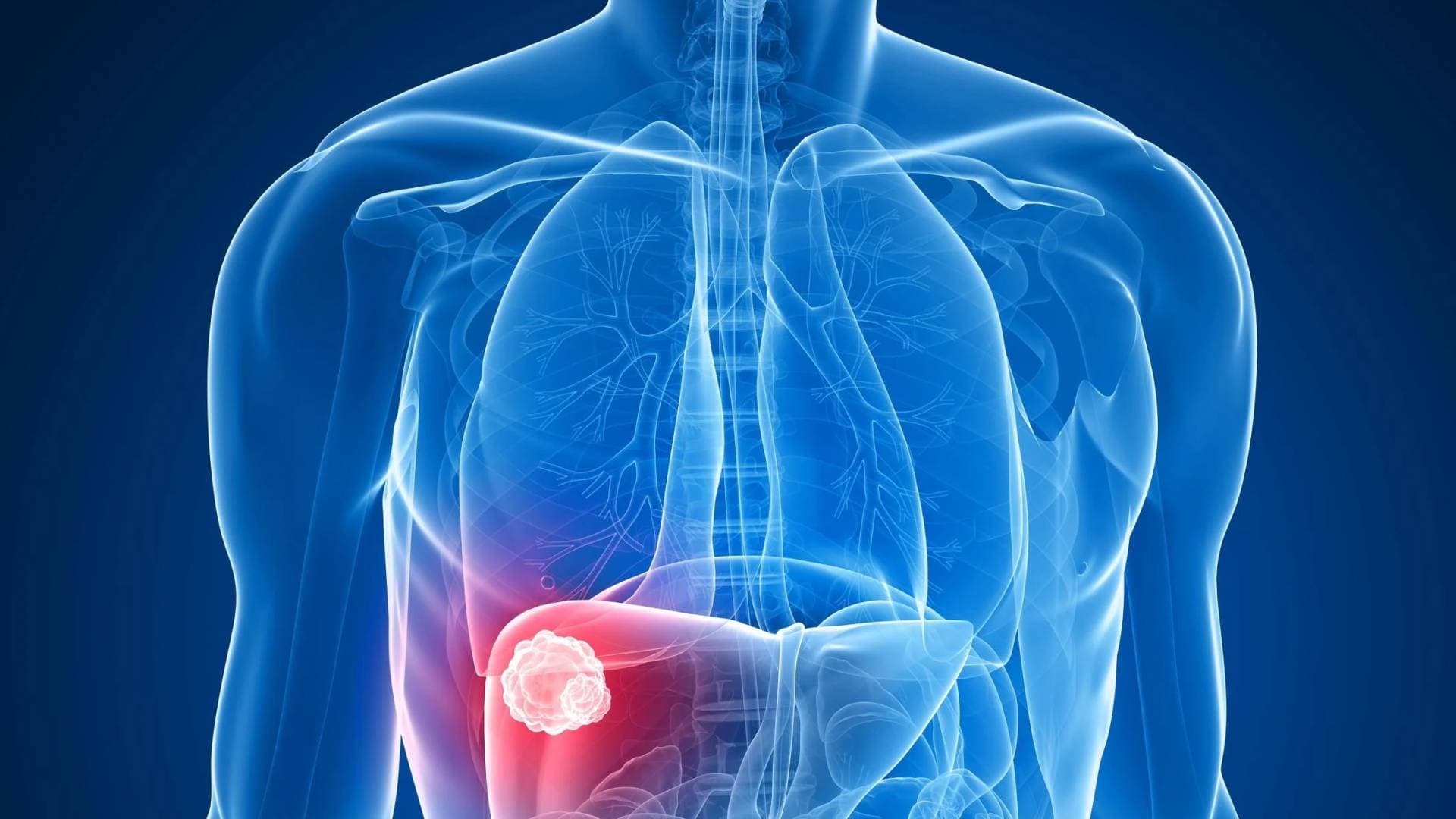 تحذير طبي نظام غذائي قد يمهد لإصابة الكبد بالسرطان على المدى الطويل