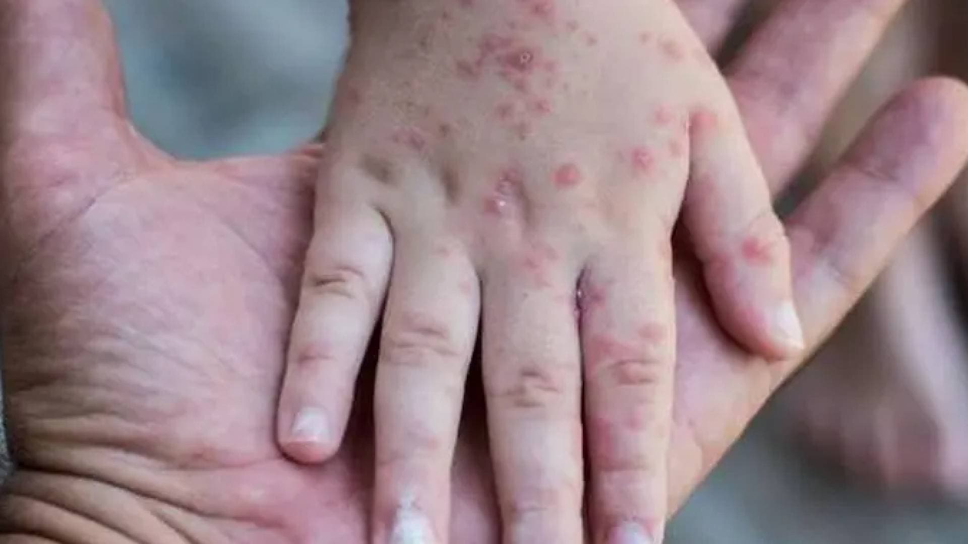 وزارة الصحة: مطعوم الجدري المائي يحمي بنسبة 97% وسيبدأ تقديمه للمواليد في 9 أيار - بالفيديو