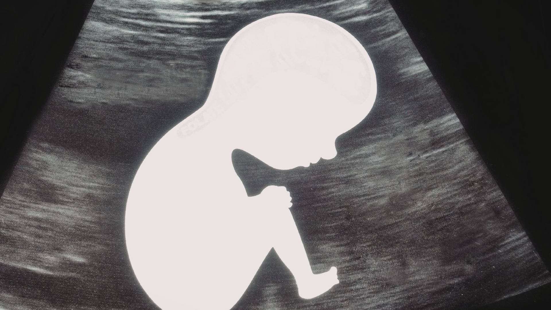 معجزة طبية في فرنسا: إنقاذ جنين من ورم قاتل داخل الرحم في سابقة عالمية